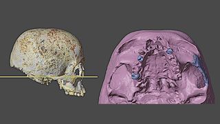 Scans of a woman's skull