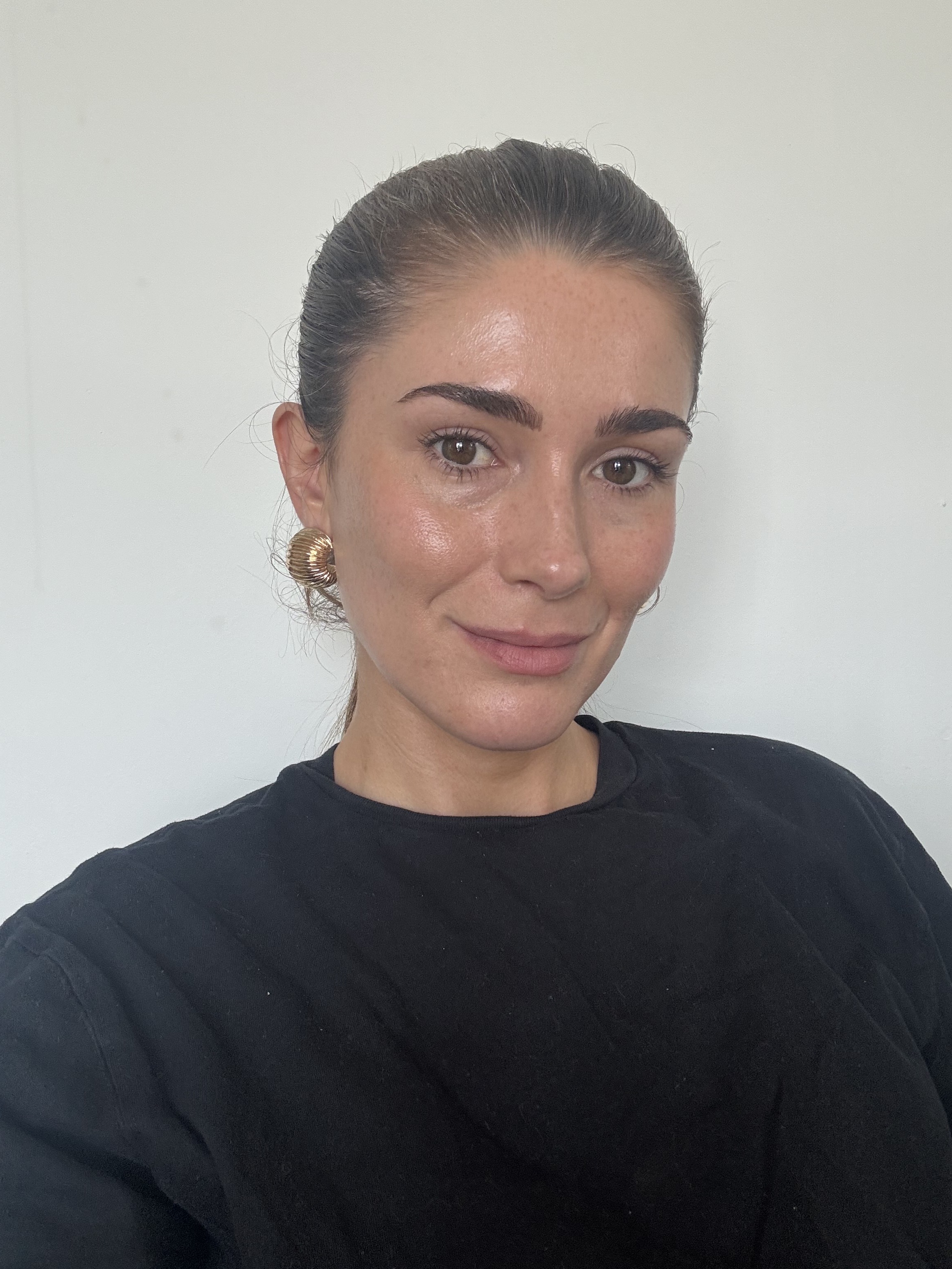 Eleanor's skin 12 weeks after testing Keskine LED mask