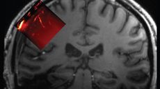 A close up on a brain scan with one portion highlighted in red, indicating the location of an implant