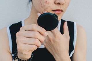 Woman looking at acne