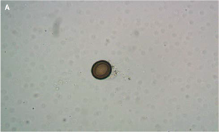 This egg from the tapeworm (seen here under a microscope) was found in the man's stool.