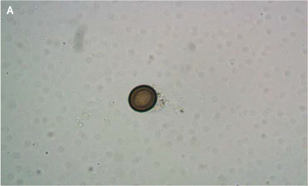 This egg from the tapeworm (seen here under a microscope) was found in the man&#39;s stool.