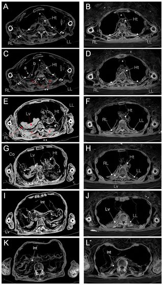 These CT images show the herniated organs of the Andong mummy (left column) and the same slices of the body from the Gangneung mummy, who didn't show signs of congenital hernia. (Symbols: Ht, heart; RL, right lung; LL, left lung; Co, Colon; Lv, Liver.)
