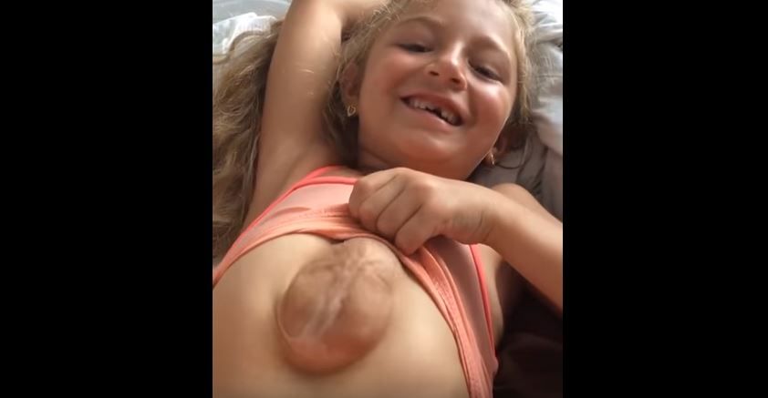 A screengrab of a video showing a girl&#039;s rare condition that causes her heart to beat outside her chest.