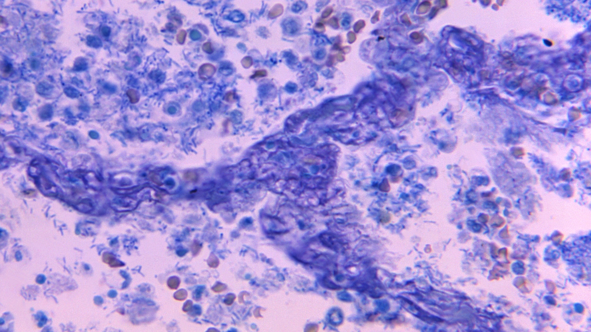 a photomicrograph of a lung tissue sample from a patient with secondary plague pneumonia