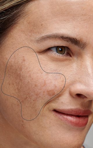 woman with dark spots outlined on face