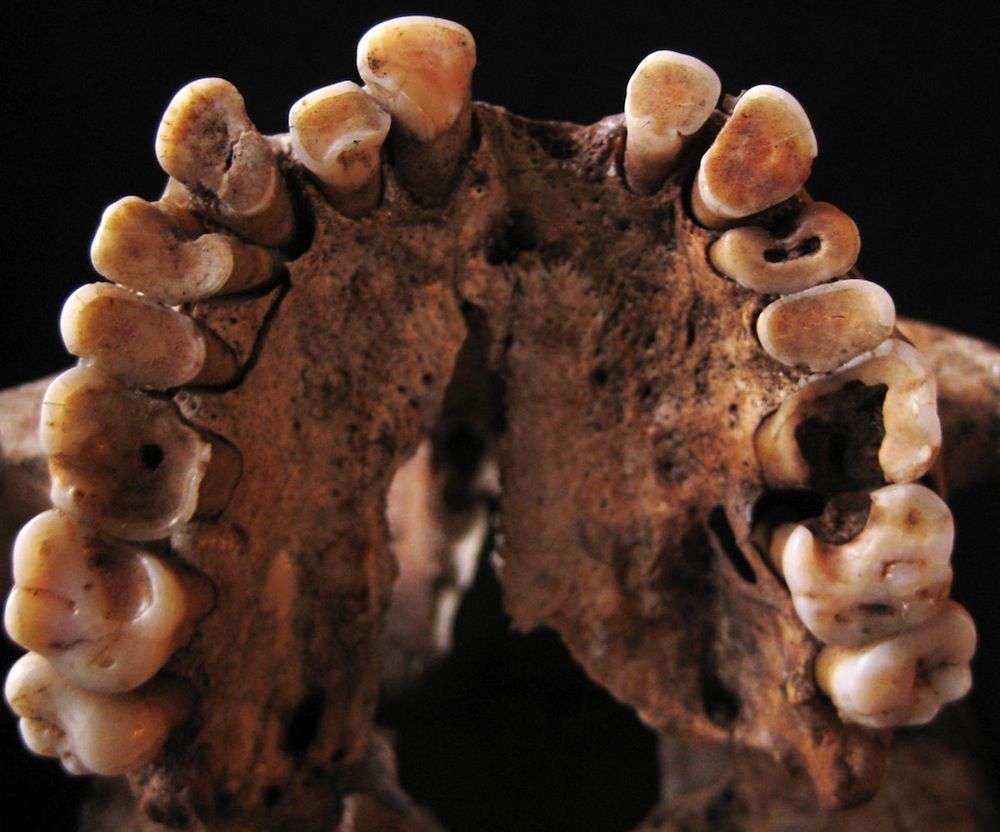 rotten teeth from paleolithic skeleton