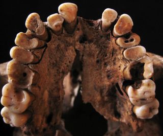 rotten teeth from paleolithic skeleton