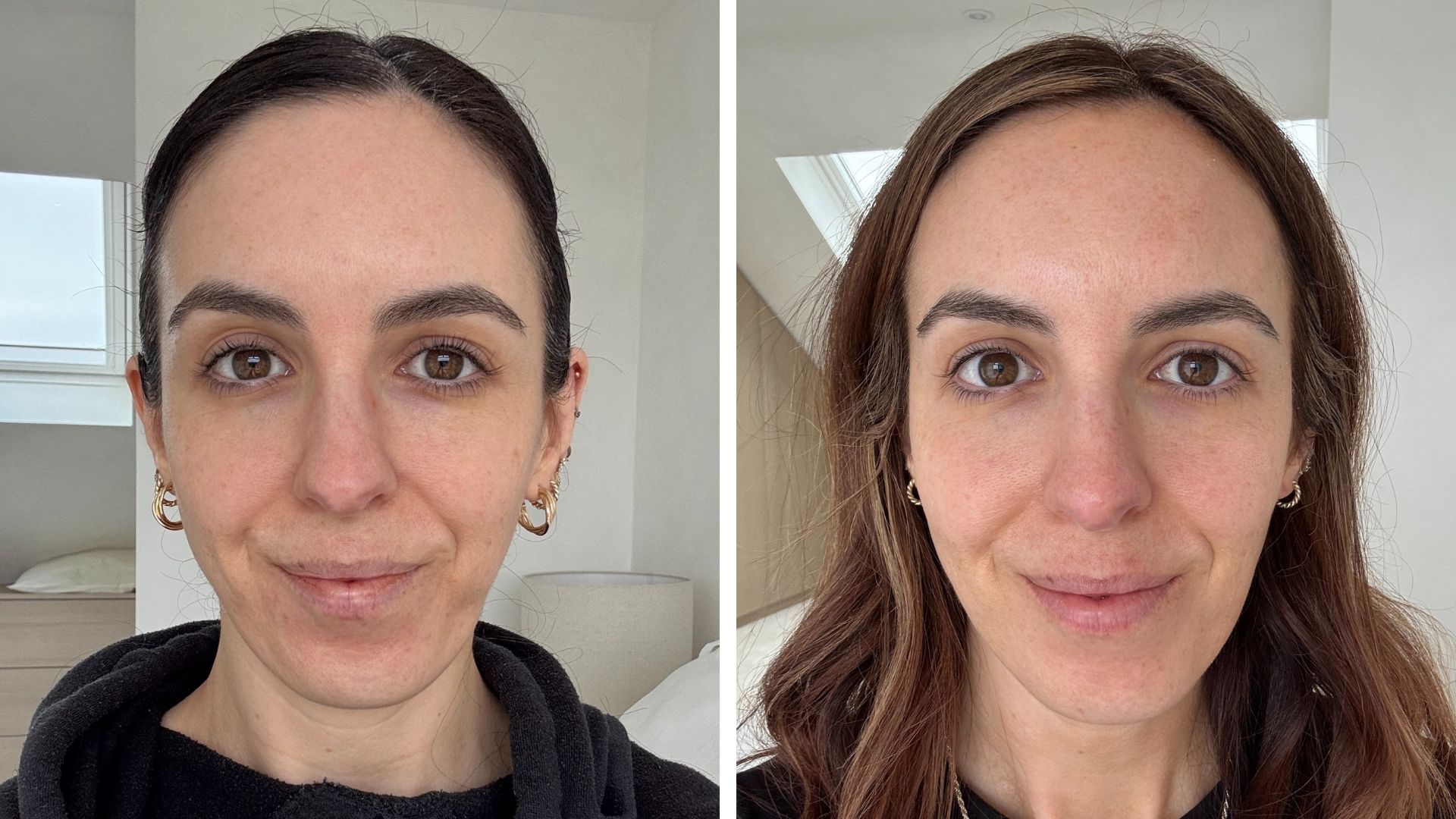 before and after of Stephanie Maylor using the Lyma for four months as past of her lyma laser review