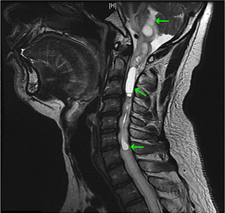 This MRI shows the extensive structure of the haemangioblastoma.