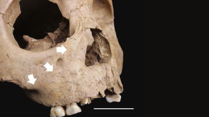 A close up of a skull with white arrows pointing to various areas on its bony cheeks with a dark background behind