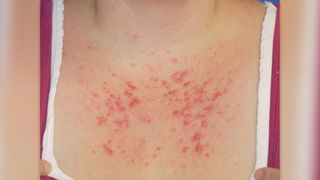 photo shows a close up of a woman's upper chest with a red, bumpy rash