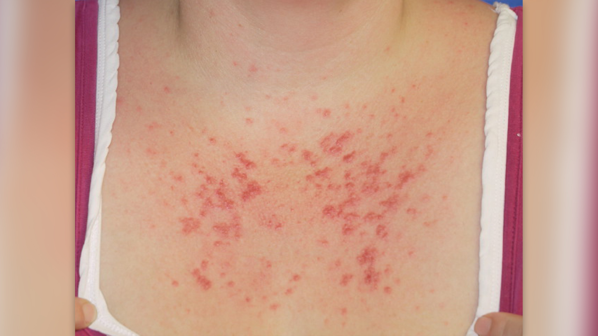 photo shows a close up of a woman's upper chest with a red, bumpy rash