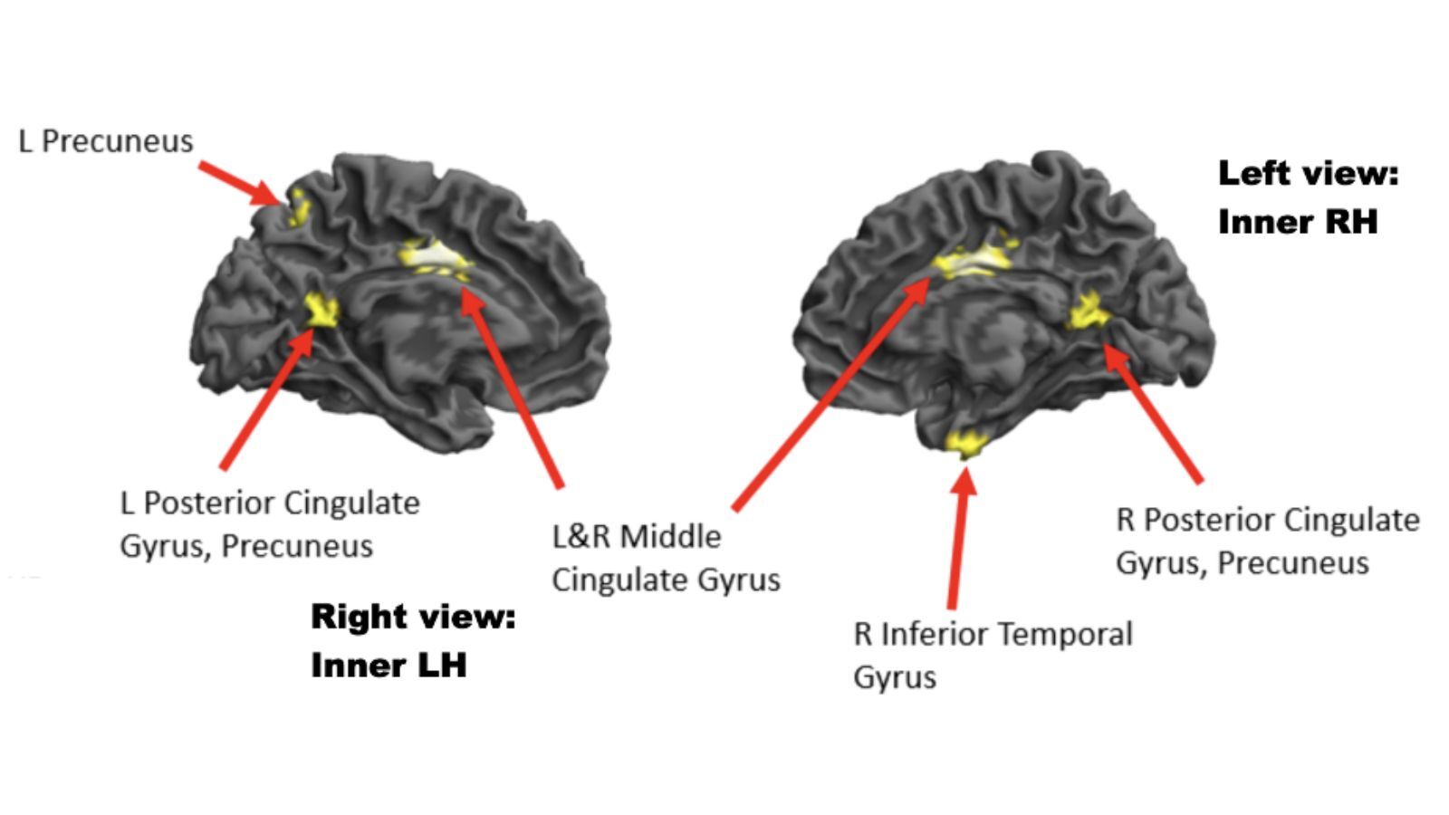 Areas of reduced brain activity when high-experience musicians were in a high-flow state, compared to a low-flow state.