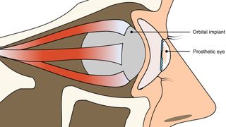 Diagram of the eye depicting the position of the ocular implant in relation to a prosthetic eye and the eyelids