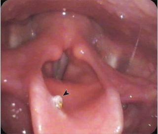 The bee stinger lodged in the teen's epiglottis, as indicated by the black arrow. Reproduced with permission from JAMA Otolaryngology-Head & Neck Surgery. 2017. doi:10.1001/jamaoto.2017.1056