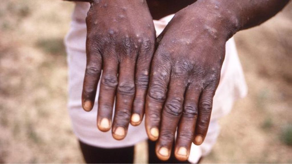 photo of the back of a child's hands; they're covered in small raised bumps due to an mpox infection
