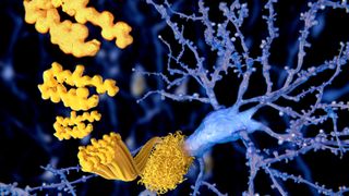Medical illustration of a neuron, in blue, in the background being surrounded by a plaque of amyloid-beta protein, in yellow with the illustration visualizing how the proteins join together 