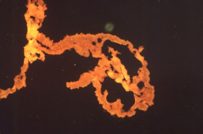 Schistosoma mansoni е разпространение на паразитен червей, когато човешката кожа влезе в контакт с заразената вода.