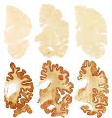 The images in the top row here show a normal brain; the images in the bottom row are of the brain of former football player Greg Ploetz, who had severe CTE.