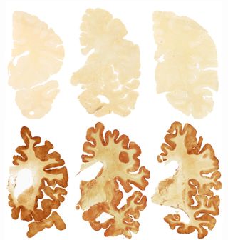 The images in the top row here show a normal brain; the images in the bottom row are of the brain of former football player Greg Ploetz, who had severe CTE.