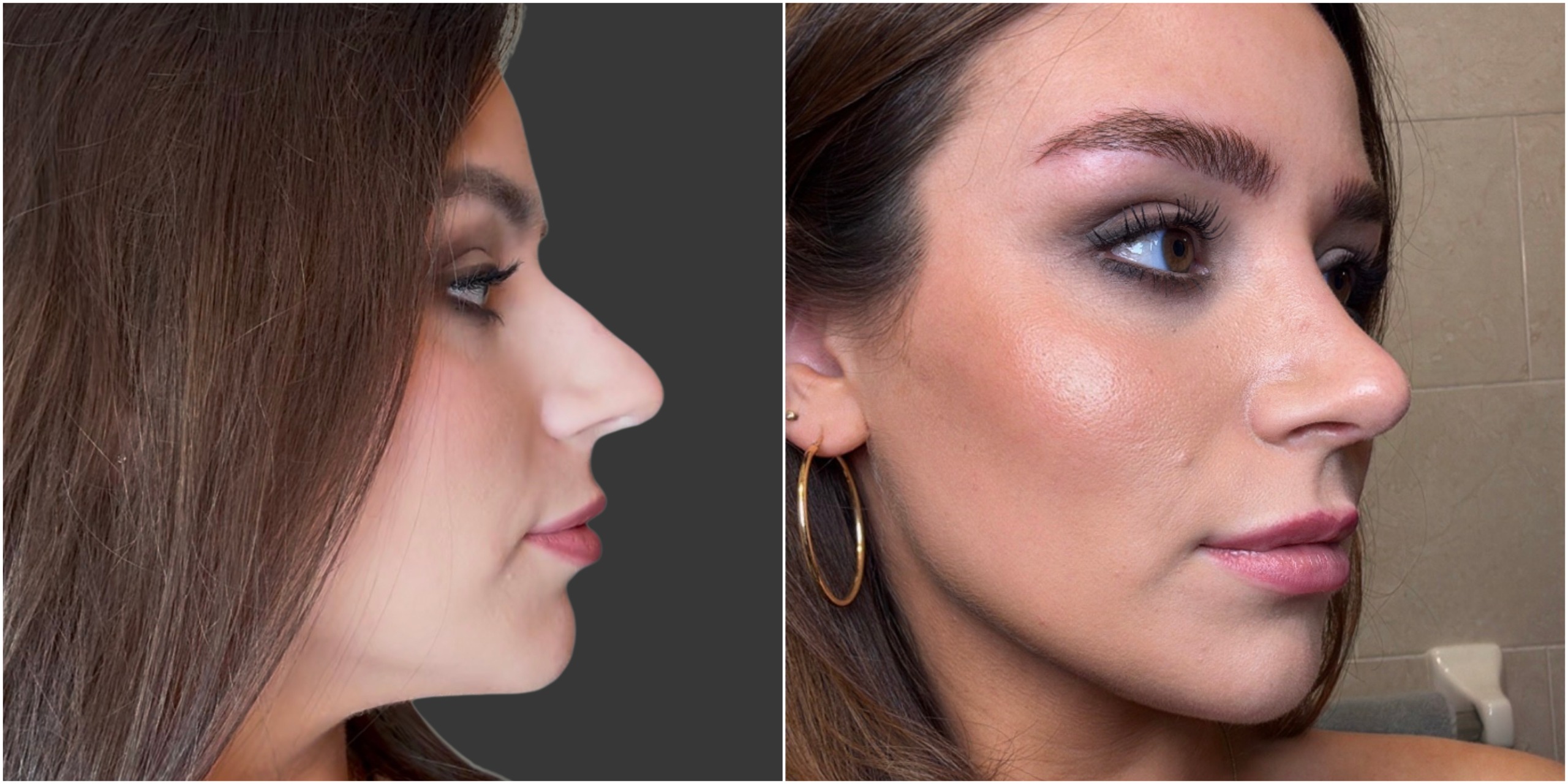 before and after a nose job procedure, side by side photos of a white woman with brown hair
