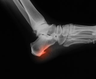 heel spur, x-ray, bone