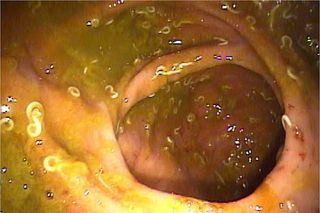 colitis-worms-101201-02