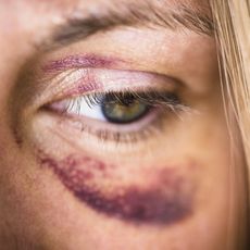 Woman Bruised Eye