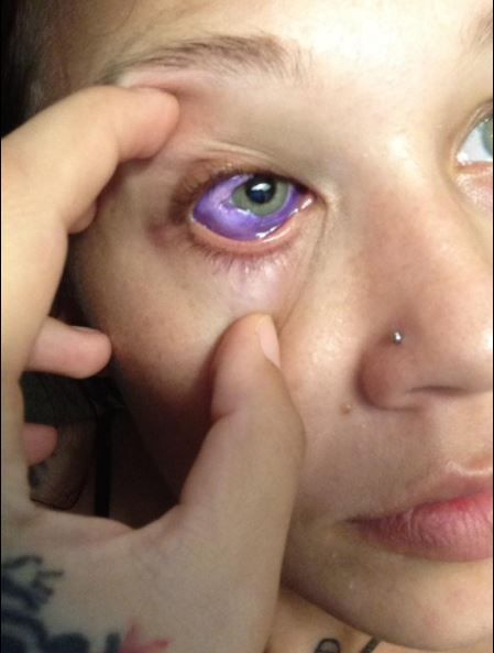 Model S Botched Eyeball Tattoo The Dangers Of Sclera Tattooing