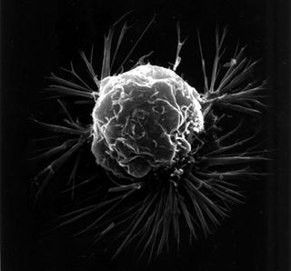 Cancer cell under electron microscope