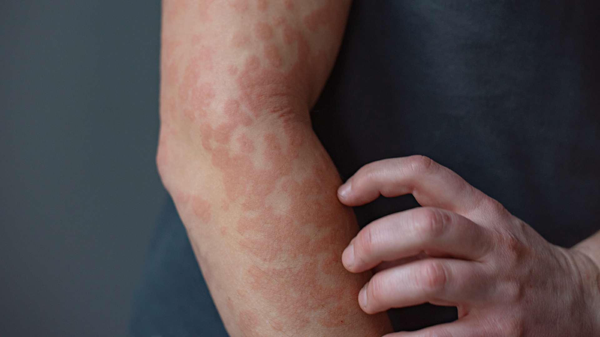A close up of a person's right forearm, covered in red circular rashes. Their left hand scratches the forearm.