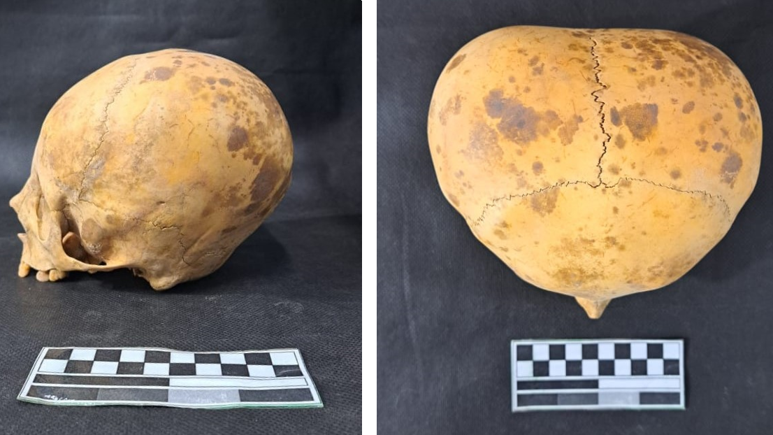 two views of a child's skull that has been flattened at the back, on black backgrounds in a lab