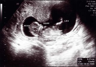 12-week sonogram