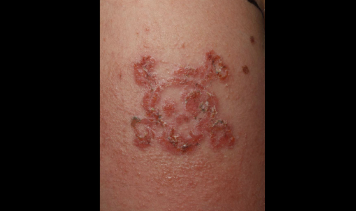Could You Be Allergic To Tattoo Ink? | New York Allergy and Sinus Centers
