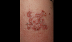 An outline of the boy's tattoo reveals inflamed skin. 
