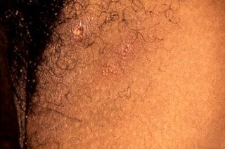 This patient has a characteristic vesiculopapular herpes simplex lesions on his anterior thigh.
