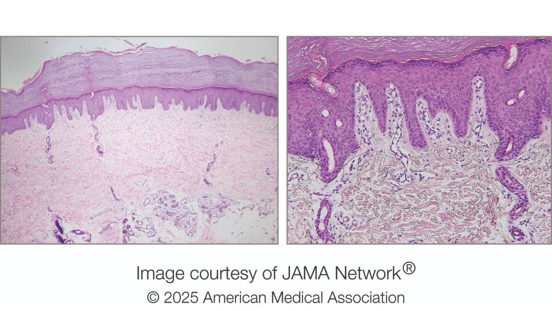 Biopsy result from skin lesion