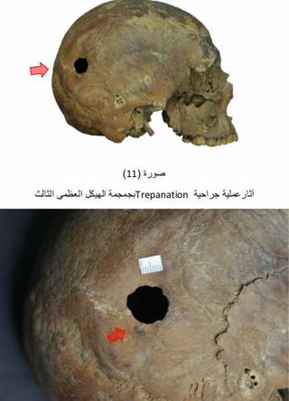 The skull of one of the men has a hole that is about 1.7 cm (0.7 inches) in diameter. This person may have undergone "trepanation," a medical procedure often used in ancient times. It was believed that it could treat a variety of medical problems.