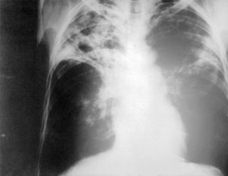 x-ray of patient with tuberculosis