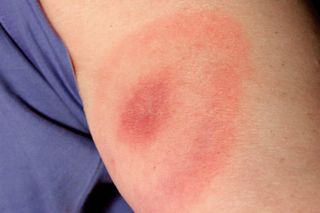 Lyme disease symptoms bulls eye rash