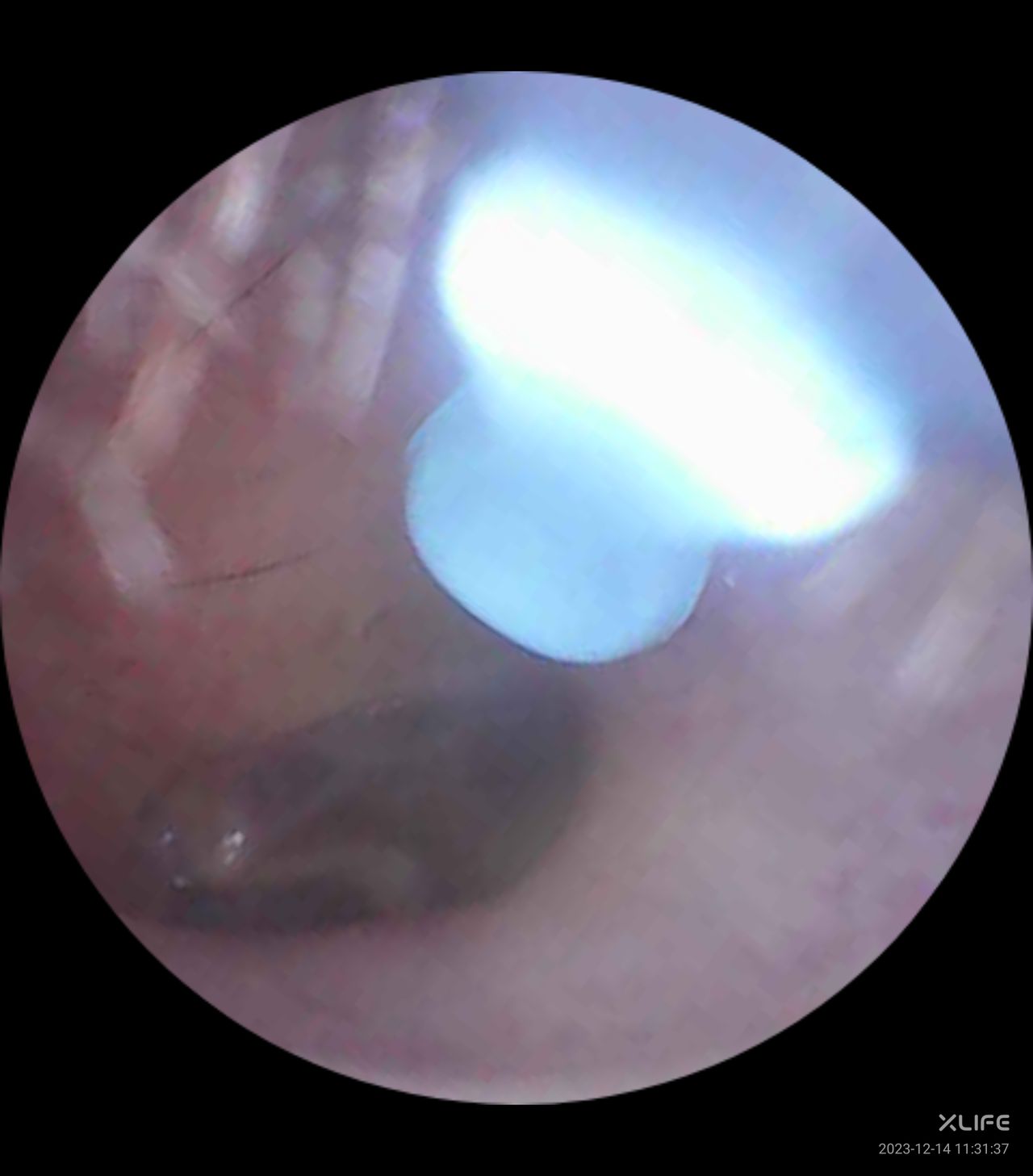 Xlife wireless otoscope ear wax removal camera app showing inside of ear.