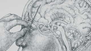 An example of a lobotomy featured in the episode "Echoes" on Lore on Amazon.