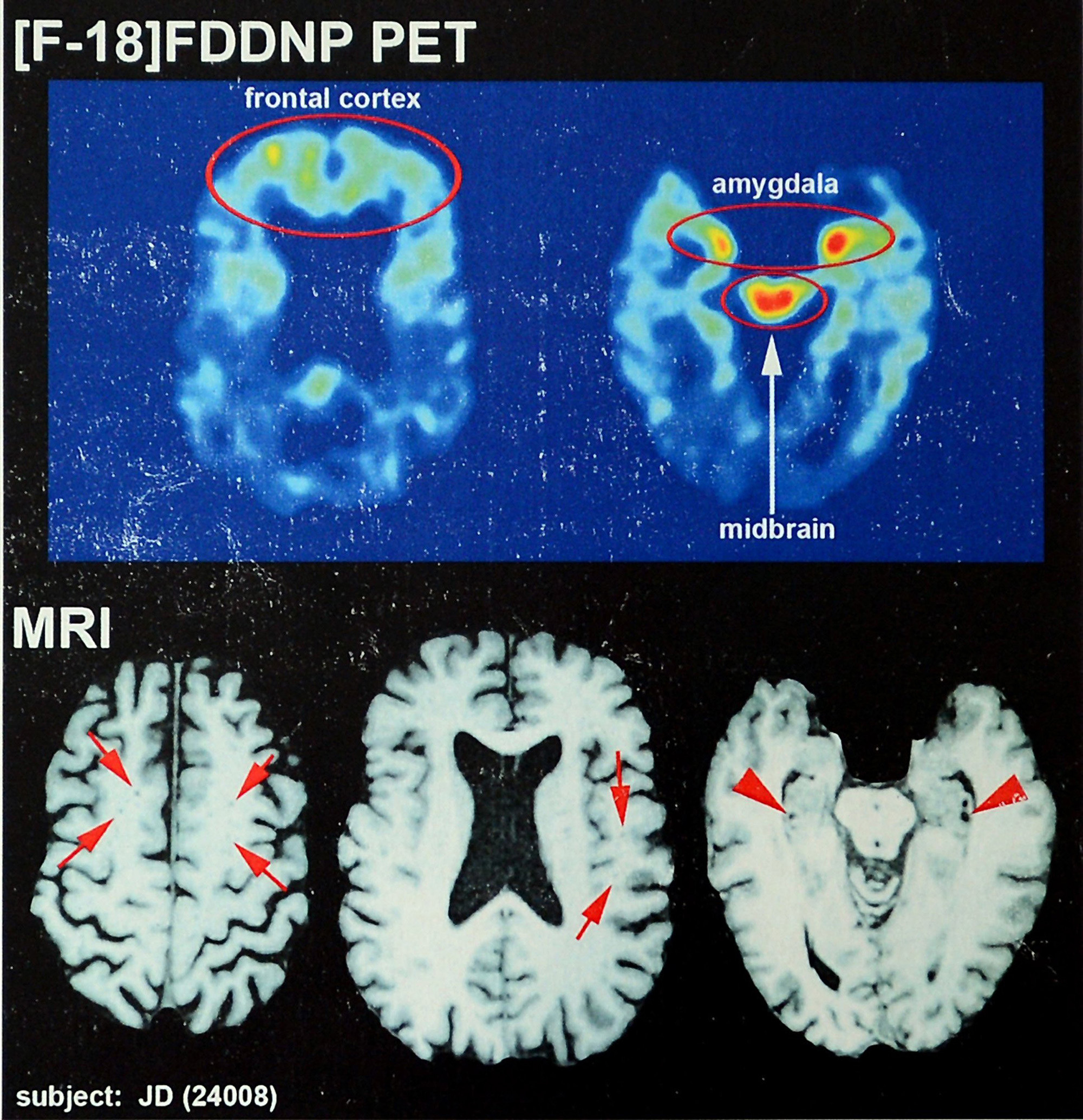 A series of brain scans with different areas of the brain circled