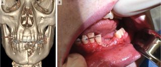 An e-cigarette explosion left a teen with a broken jaw and multiple missing teeth. Above, an image (created from CT scans) showing the boy's jaw injury and damaged teeth (left); and a photo of the teen six weeks later, when his jaw had healed (right). The