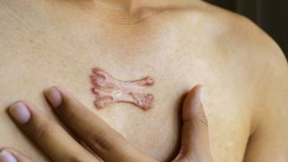 Close-up of a keloid scar on a person's chest. They are holding their hand to their chest underneath the scar.