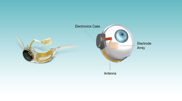 Argus II artificial retina