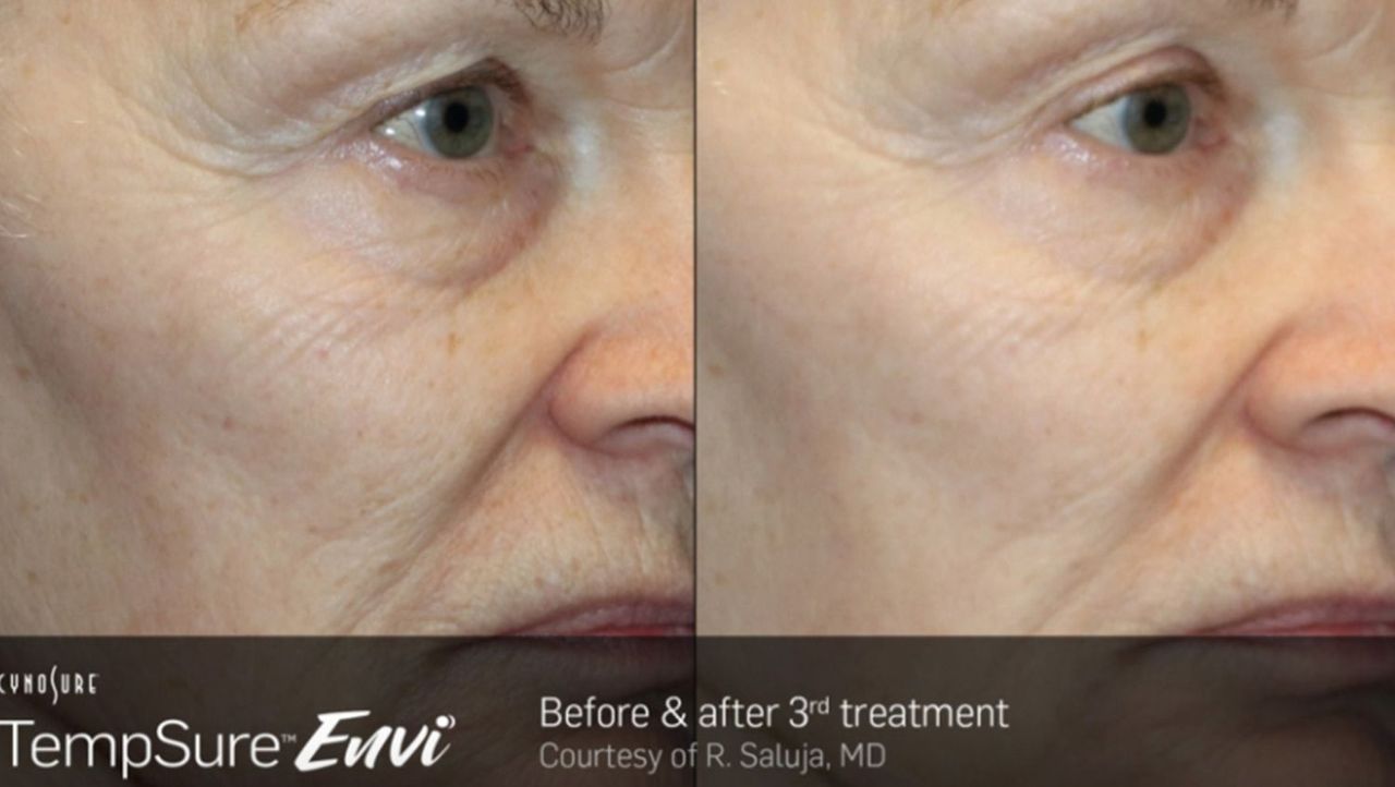 TempSure Is a NonSurgical, Painless Face Lift TempSure Before and
