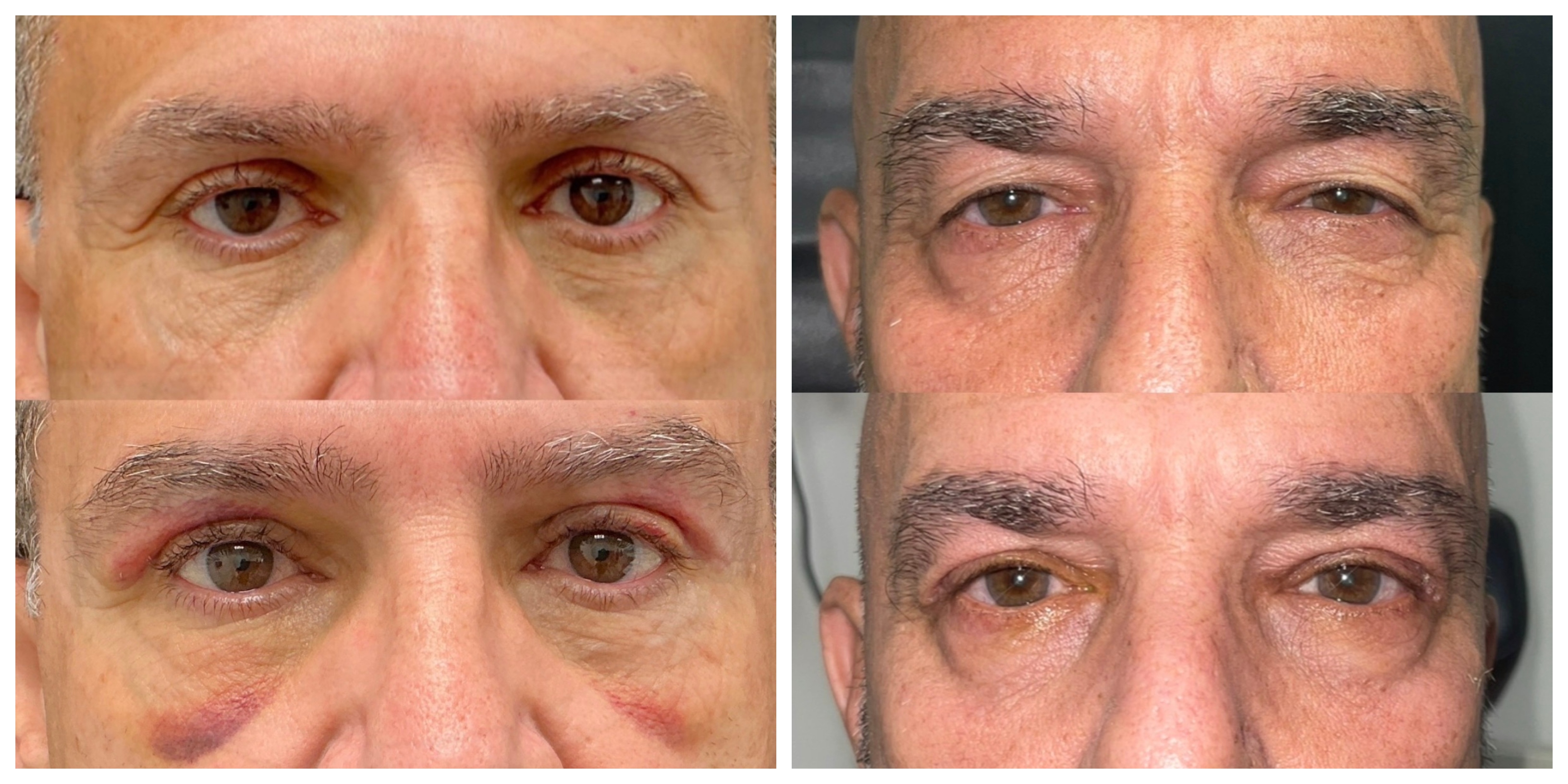 two before-and-after photos of white men after bleph surgery