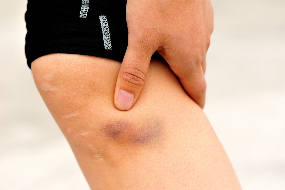 Does Cancer Make You Bruise Easily